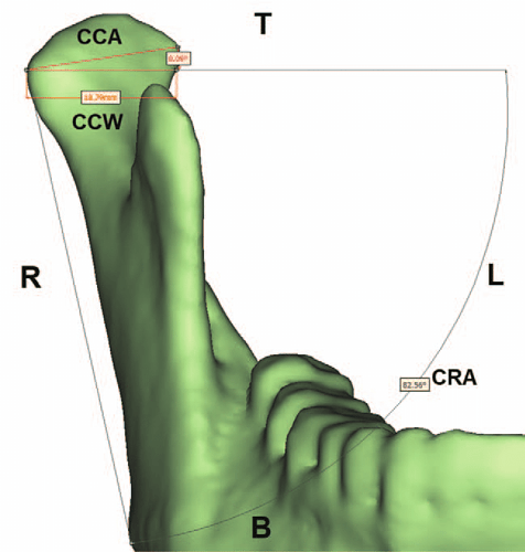 Measurements-of-the-CCW-CCA-and-CRA-on-the-3D-models-3D-three-dimensional-B-the.ppm